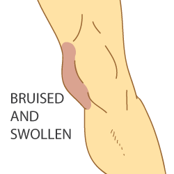 Symptoms of a Re-Injured MCL