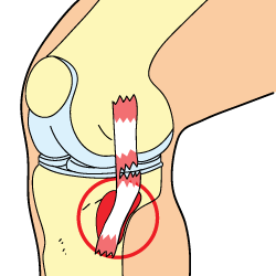 Knee Bursitis