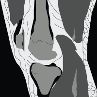 MCL Tear MRI