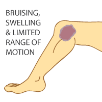 MCL Tear Symptoms