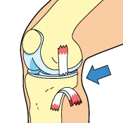 Complete MCL Tears May Require Surgery