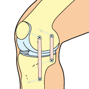 MCL Reconstruction