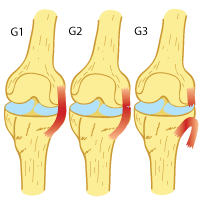 Time Frame for MCL Injury