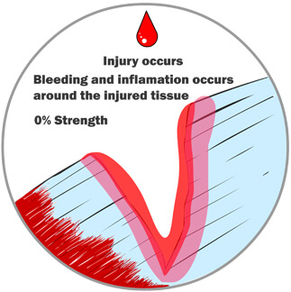 Right After the Injury Occurs, Bleeding and Inflammation Begin