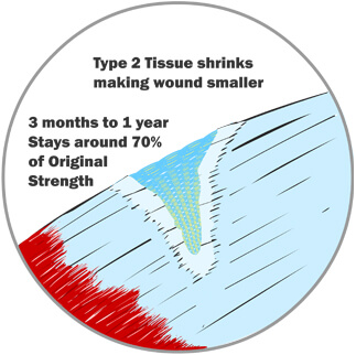 Type 2 Tissue Shrinks, Pulling in the Wound